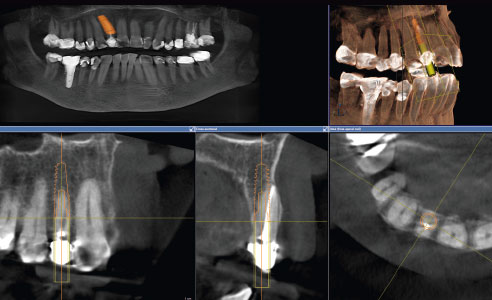 Fig. 4: La planificación regresiva posibilitó el posicionamiento protésico ideal del implante en el hueso maxilar.