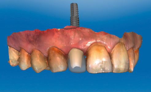 Fig. 8: A VITA ENAMIC IS abutment and a polychromatic ceramic crown (VITABLOCS TriLuxe forte) were digitally designed.