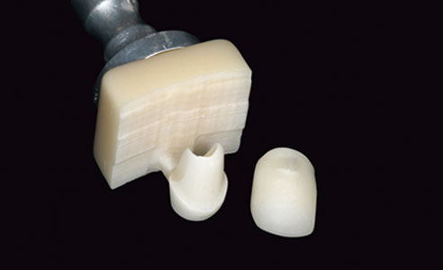 Fig. 9: The feldspar ceramic crown and the VITA ENAMIC IS mesostructure immediately after grinding.