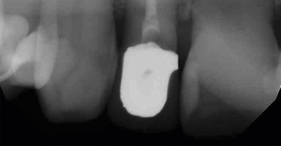 Abb. 1: Die Wurzel von Zahn 12 war aufgrund von Überlastung frakturiert.
