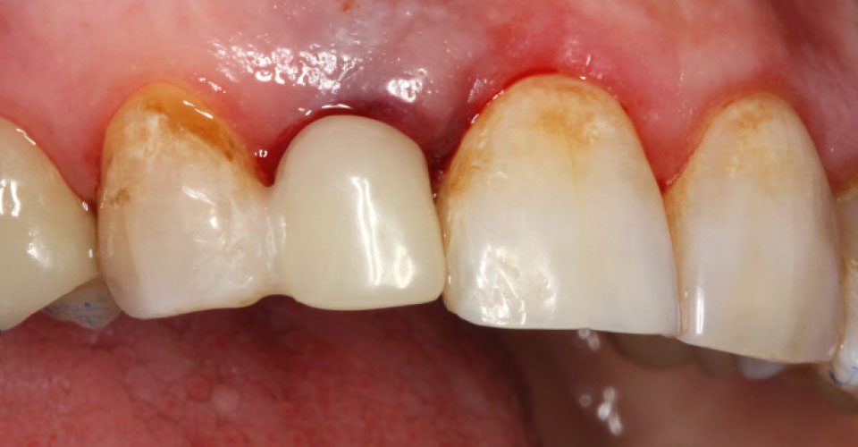 Fig. 3: Una corona provvisoria è stata incollata provvisoriamente al dente contiguo per conformare e stabilizzare i tessuti molli.