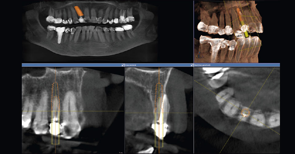 Ill. 4 : Grâce au Backward Planning, un positionnement idéal de la prothèse implantaire dans l'os de la mâchoire a été rendu possible.