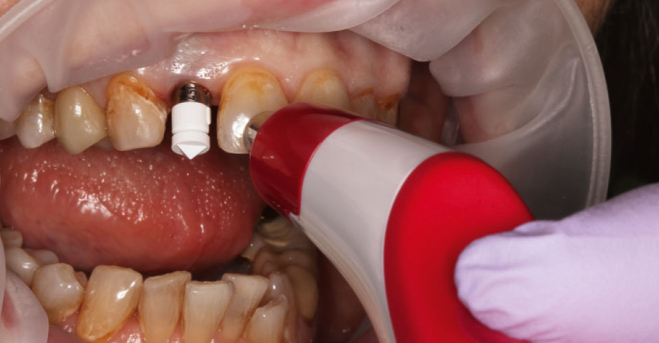 Fig. 7: Se atornilló al implante un cuerpo de escaneo y se determinó el color dental utilizando el VITA Easyshade V.