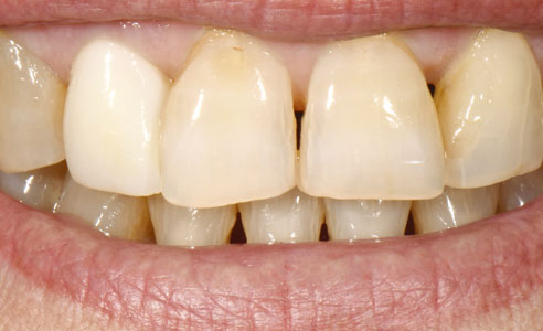 Fig. 1: Situación de partida: Estado del diente 12 tras la preparación de corona completa, el escaneo intraoral y la restauración provisional.