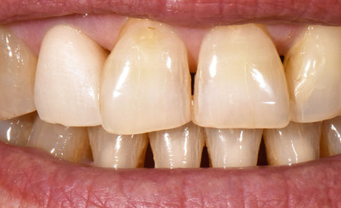 Ill. 3 : L'essayage réalisé après la première cuisson de dentine montre encore une couronne beaucoup trop claire.