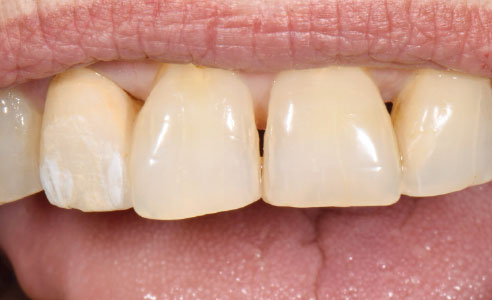 Fig. 4: The play of shade at the incisal edge and the body area was reproduced with VITA AKZENT Plus CHROMA STAINS A and B.