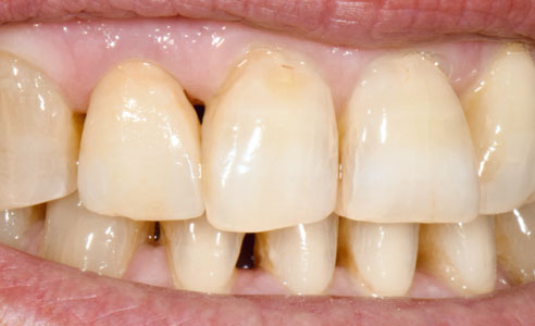 Ill 5 : Après la cuisson des colorants, la patiente tout comme le dentiste étaient satisfaits du résultat.
