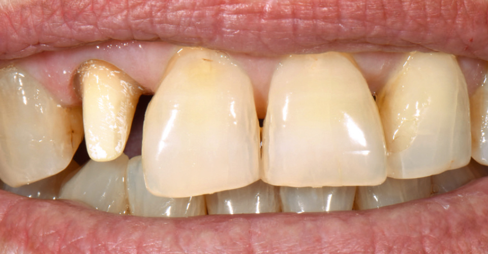Fig. 2: Il provvisorio è stato tolto per la prova dopo la prima cottura della dentina e quella dei supercolori.