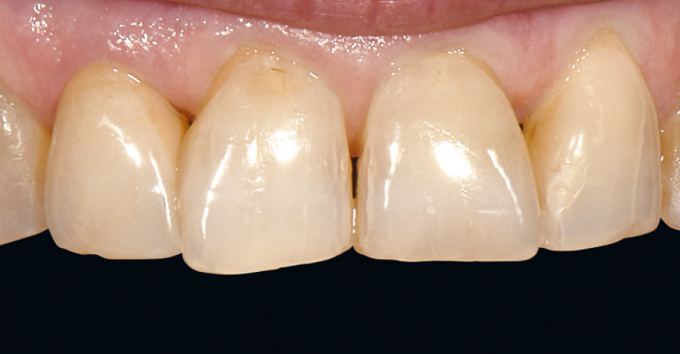 Fig. 6: Risultato: La corona è stata lucidata e integrata definitivamente. Il restauro si armonizza con i tessuti dentari residui.
