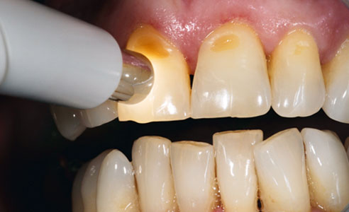 Fig. 1: 1 La determinación del color dental con el VITA Easyshade V se realizó con facilidad y rapidez pulsando un botón.