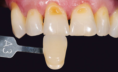 Fig. 3: Dente misurato e campione del colore determinato dal VITA Easyshade V.