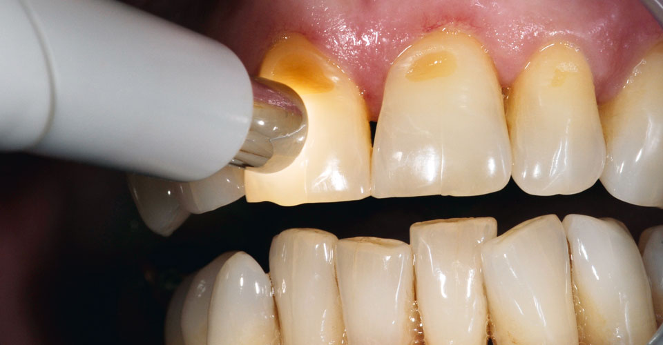 Fig. 1: 1 La determinación del color dental con el VITA Easyshade V se realizó con facilidad y rapidez pulsando un botón.
