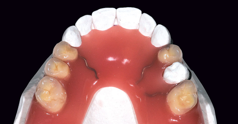 Fig. 4: La prótesis provisional terminada con ganchos doblados en los dientes 13, 23 y 25.