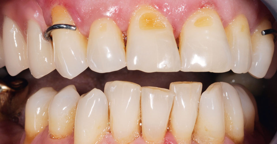 Fig. 6: Colore e morfologia dei denti si armonizzano con la dentatura residua.