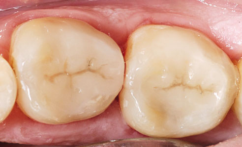 Fig. 10: Grazie all'eccellente effetto camaleonte gli inlay in ceramica ibrida si fondono otticamente con la sostanza dentaria.
