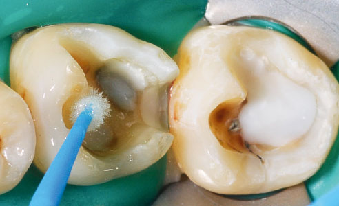Fig. 7: Sobre la sustancia dental dura se aplicó VITA ADIVA T-BOND I+II para lograr una fijación totalmente adhesiva.