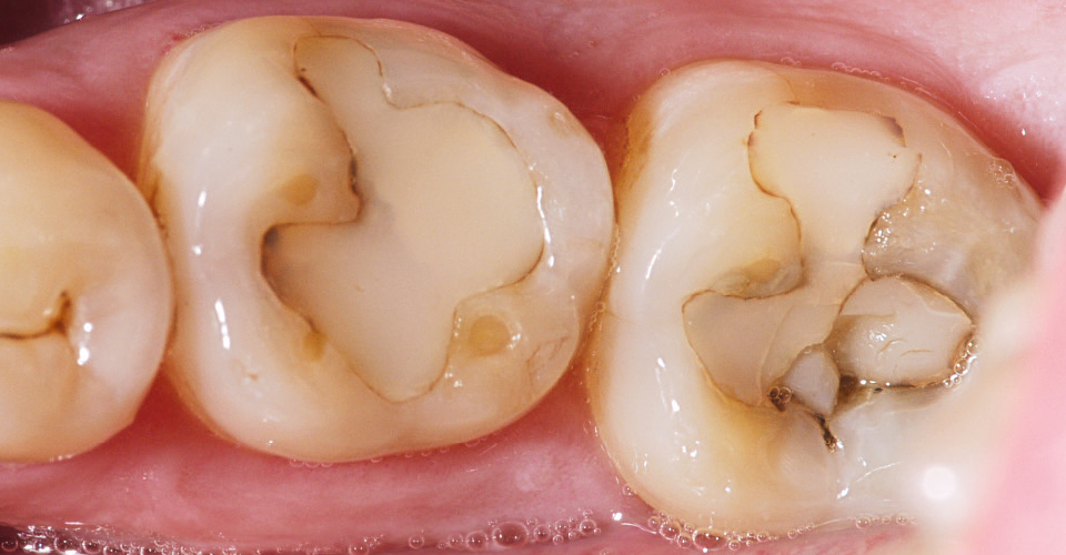 Fig. 1: La situación de partida con la obturación de composite fracturada en el diente 37 y márgenes insuficientes y tincionados en el diente 36.
