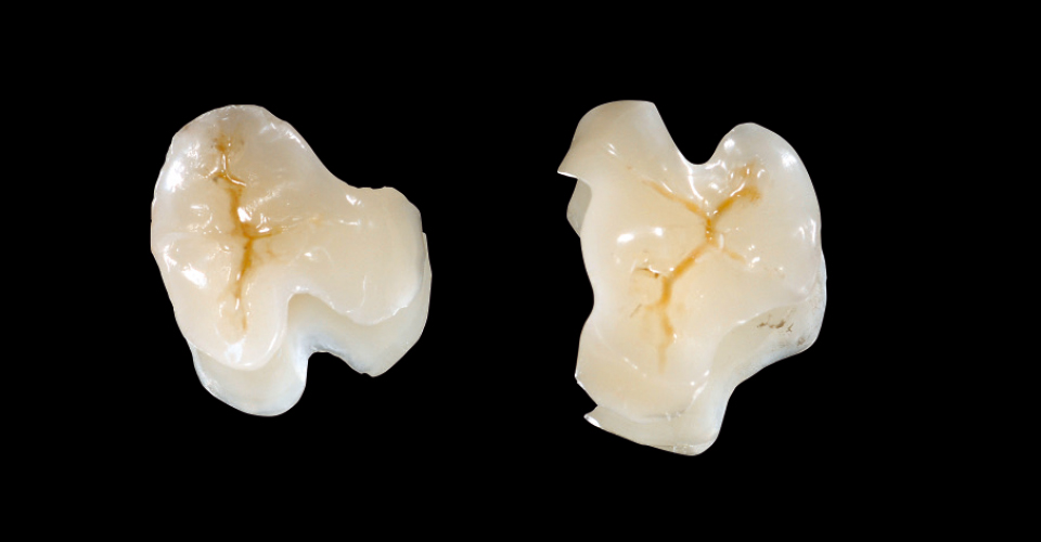 Fig. 3: Los inlays terminados para los dientes 36 y 37 tras el acabado y la personalización.