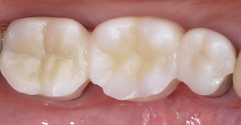 Abb. 7: Die mesiovestibuläre Reduktion an Zahn 45 ermöglichte es, einen harmonischen Übergang zu kreieren.