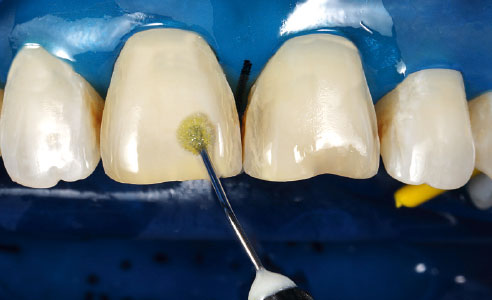 Abb. 14: Auf die Zahnoberflächen wurde ein lichthärtendes Einkomponentenadhäsiv appliziert.