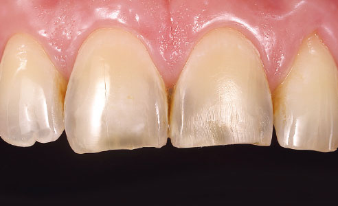 Fig. 1: Situación de partida: La erosión y la abrasión habían conducido al acortamiento de la zona incisal y a la pérdida de la morfología de los dientes 11 y 21.
