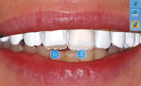 Fig. 8: Mediante la aplicación CEREC-Smile Design se pueden evaluar las restauraciones junto con los labios.