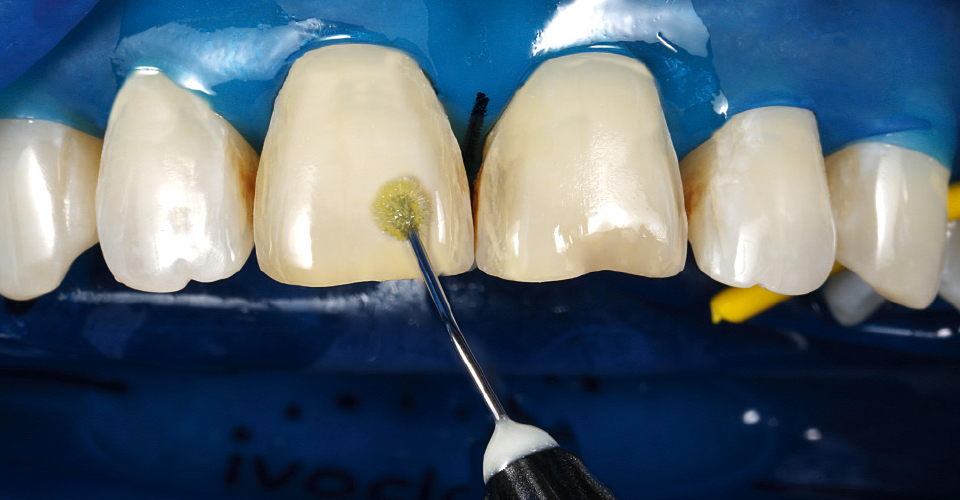 Ill. 14 : Un adhésif monocomposant photopolymérisable a été appliqué sur la surface des dents.