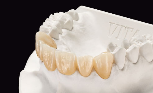 Fig. 2: Puente de dientes anteriores de dióxido de circonio VITA YZ® ST parcialmente recubierto con VITA VM 9.