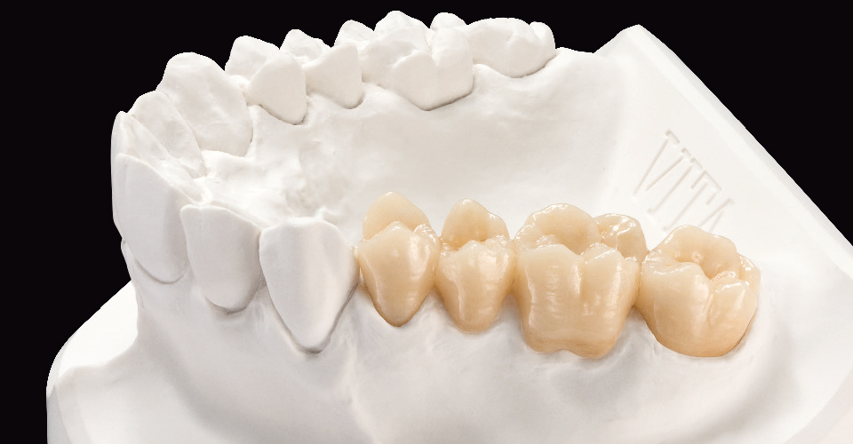 Fig. 3: Puente de dientes posteriores monolítico de dióxido de circonio VITA YZ® ST, maquillado con VITA AKZENT Plus.