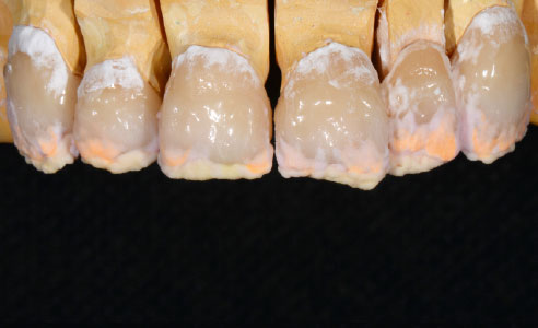 Fig. 5: After the first firing, cervical EL4 (yellow), incisal BD 2M1 and MM3 (light orange) were applied.