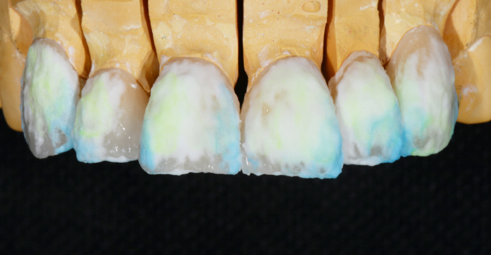 Fig. 9: Lateral layering using E01 (neutral) and E03 (bluish). Incisal and medium-level whitening ENL.