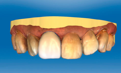 Fig. 4: After the intraoral scan, the shape of the crown was virtually designed.