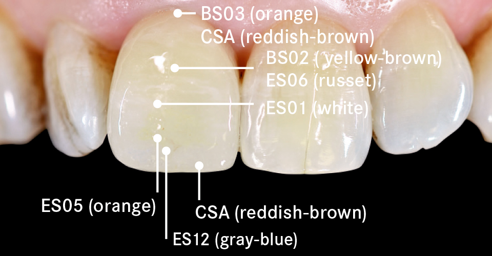 Fig. 8: The crown was individually characterized with VITA AKZENT Plus stains.
