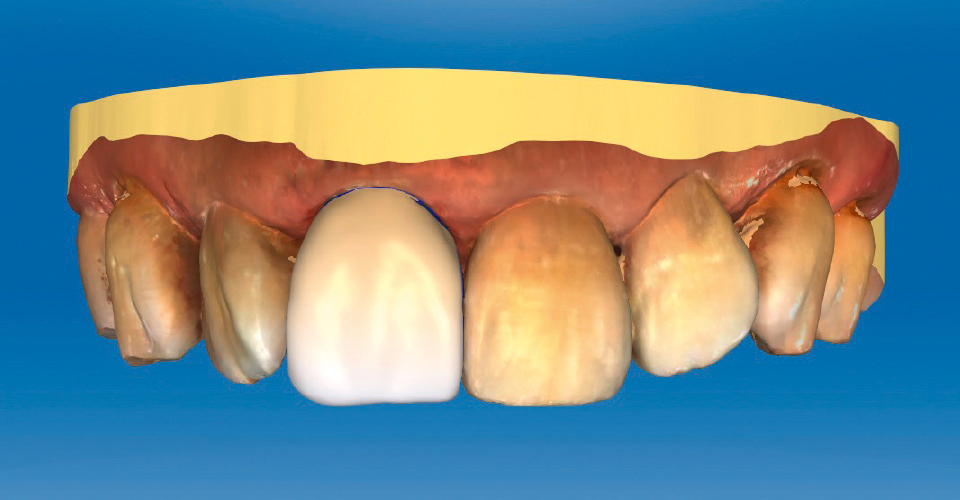 Fig. 4: After the intraoral scan, the shape of the crown was virtually designed.