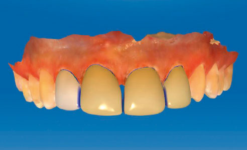Fig. 10: The designed veneers were very graceful, due to the lower minimum layer thickness of the hybrid ceramic.