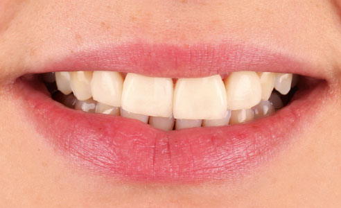Fig. 1: A young female patient was dissatisfied with her veneer restorations made of glass ceramic.
