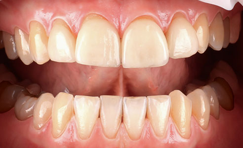 Fig. 2: Las restauraciones en los dientes 12, 11, 21 y 22 presentaban déficits en cuanto al contorno incisal.