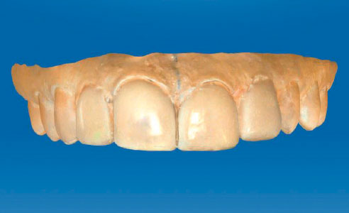 Fig. 6: A wax-up provided orientation and helped with the later construction in digitized form.