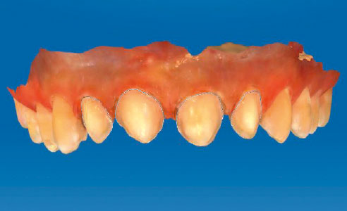 Ill. 7 : Remodelage mini-invasif du contour de la surface dentaire vestibulaire avec des limites de préparation définies.