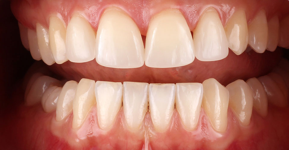 Fig. 13: The restorations were integrated in shape and shade into the residual tooth substance.