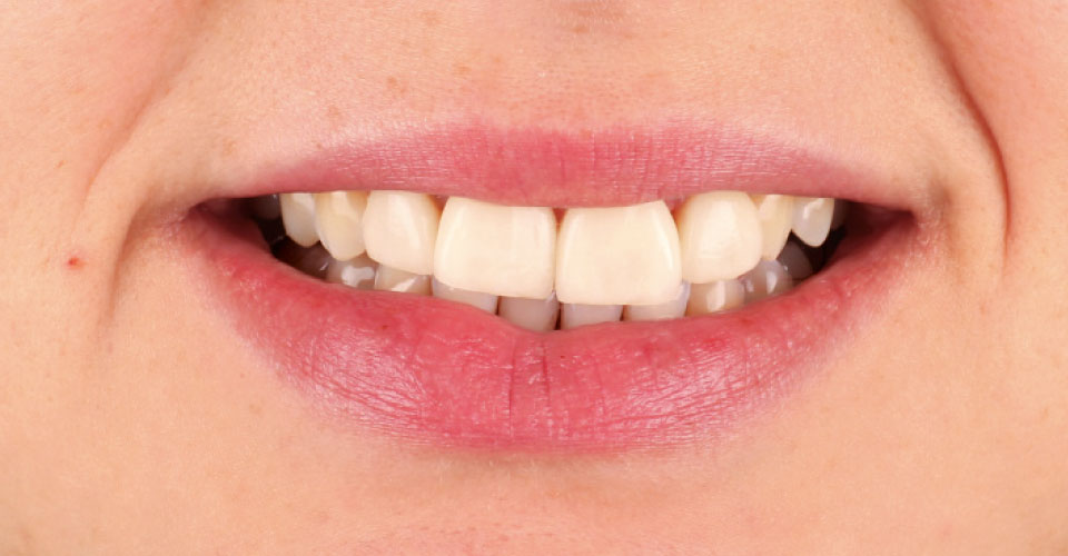 Ill. 1 : Une jeune patiente était insatisfaite de ses facettes dentaires en vitrocéramique.