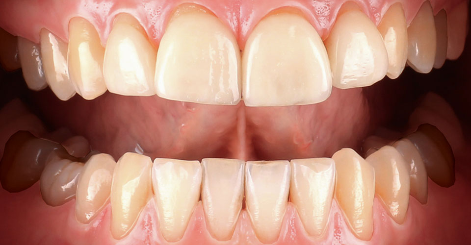 Fig. 2: The restorations at 12, 11, 21 and 22 showed deficits at the incisal edges.