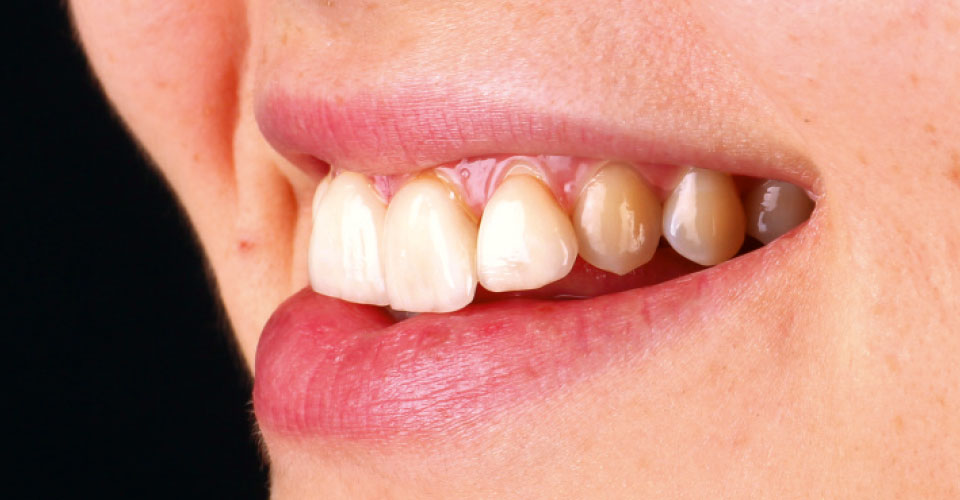 Fig. 3: La arcada dentaria no armonizaba con el contorno de los labios.