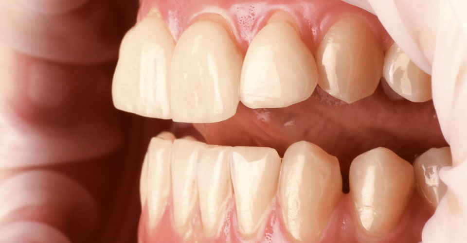 Fig. 4: Los ejes dentales de los incisivos eran irregulares. Las carillas presentaban un aspecto tosco y artificial.