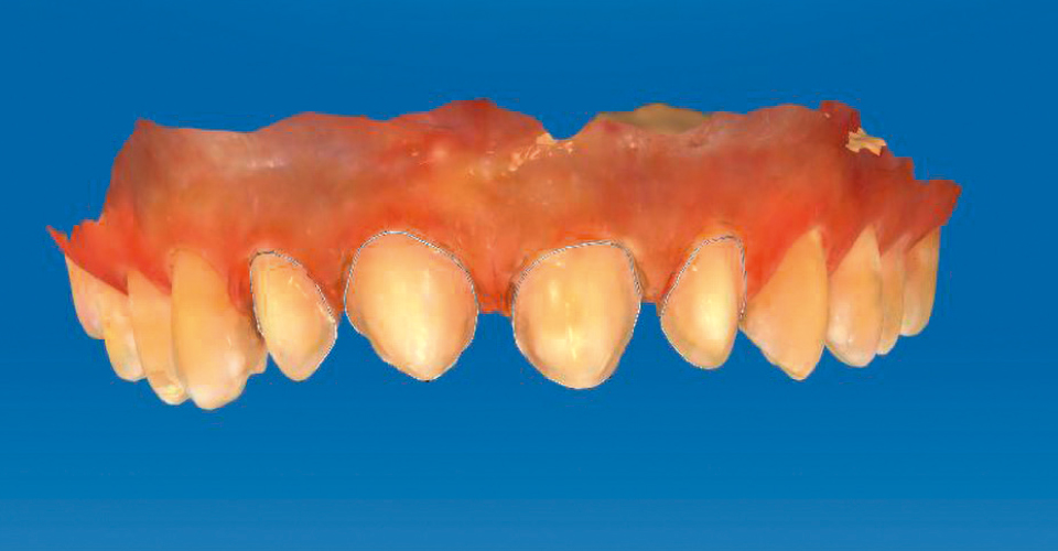 Ill. 7 : Remodelage mini-invasif du contour de la surface dentaire vestibulaire avec des limites de préparation définies.