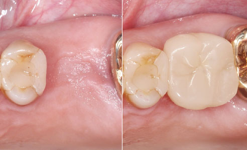 Abb. 1: Ausgangssituation nach der Extraktion von Zahn 26 und Abheilphase. Abb. 15: Ergebnis: Nach dem Verschluss des Schraubenkanals mit Komposit ist dieser nicht mehr sichtbar.