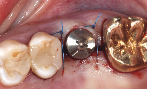 Fig. 5: Il formatore gengivale è stato avvitato e l'area operativa suturata microchirurgicamente.