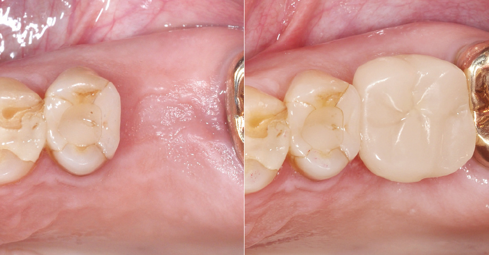 Fig. 1: Situación de partida tras la extracción del diente 26 y la fase de cicatrización.Fig. 15: Resultado: El conducto para tornillo ya no es visible tras su sellado con composite.