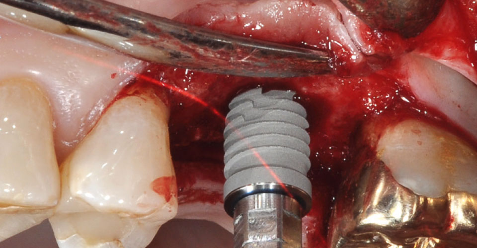 Fig. 4: Se inserta el implante en el lecho óseo preparado.