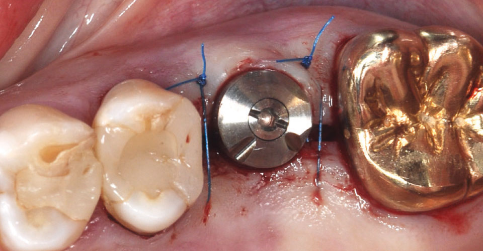 Fig. 5: Se atornilló el pilar de cicatrización y se suturó microquirúrgicamente la zona de la operación.